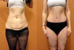 Eu vou te auxiliar na redução de gordura pós gestação